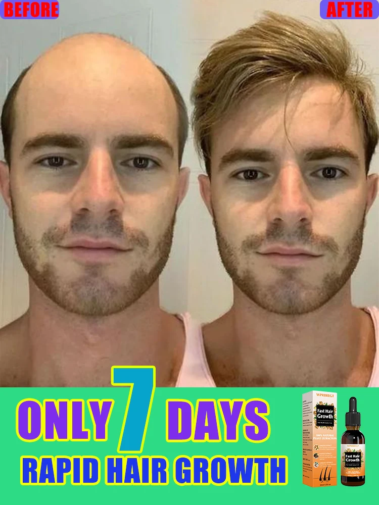 

Hᴀɪʀ ɢʀᴏᴡᴛʜ ᴇssᴇɴᴄᴇ ᴡɪʟʟ ʟᴇᴛ ʏᴏᴜ sᴀʏ ɢᴏᴏᴅʙʏᴇ ᴛᴏ ʙᴀʟᴅɴᴇss