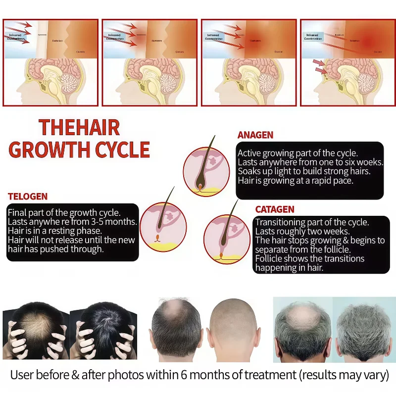 

Профессиональный лазерный колпачок для роста волос, 96 диодов, LLLT 650 нм, 5 МВт, терапия красным светом для ухода за кожей головы и лечения выпадения волос
