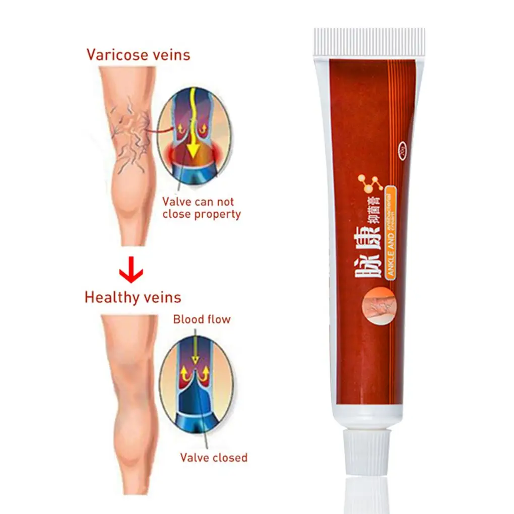 Pomada para venas varicosas, crema Herbal para Vasculitis, flebitis, arañas