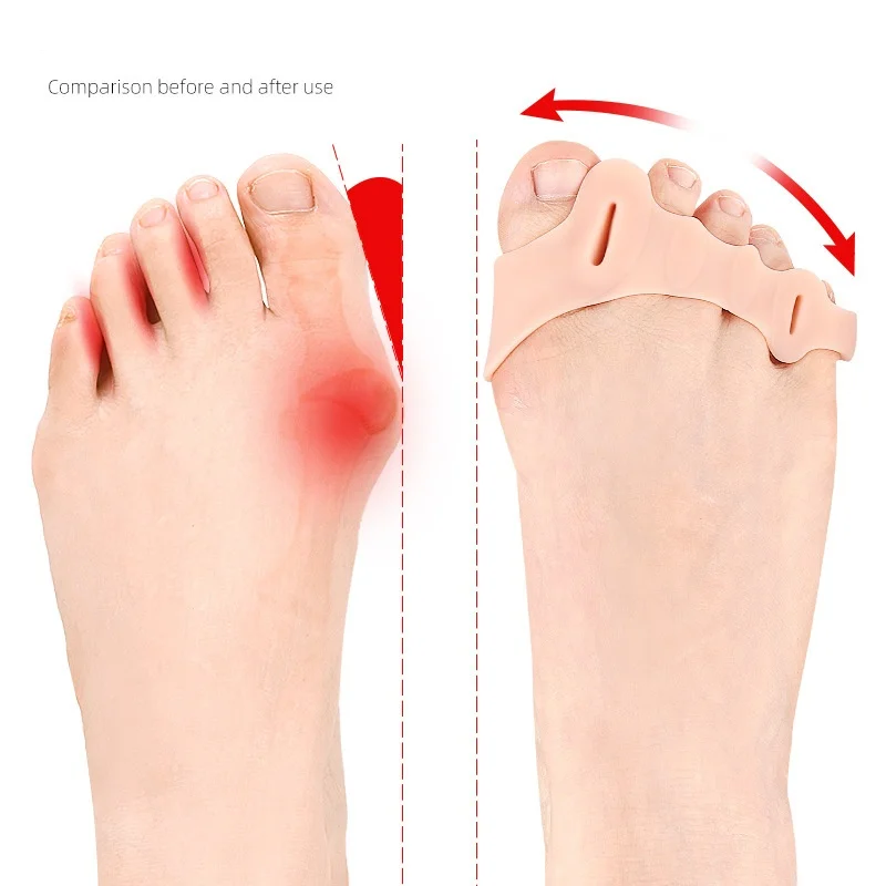 Forefoot Pad Five-hole Toe Divider Five-toe Arch Soft And Pressure-relieving Massage Pad For Hallux Valgus Orthosis 2pairs/sets