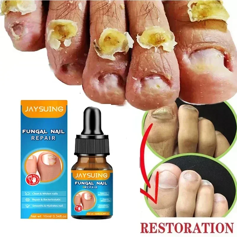 

1/2/4/5PCS Nail Fungal Treatment Feet Care Essence Repair Nail Fungus Removal Serum Gel Anti Infection Paronychia Onychomycosis