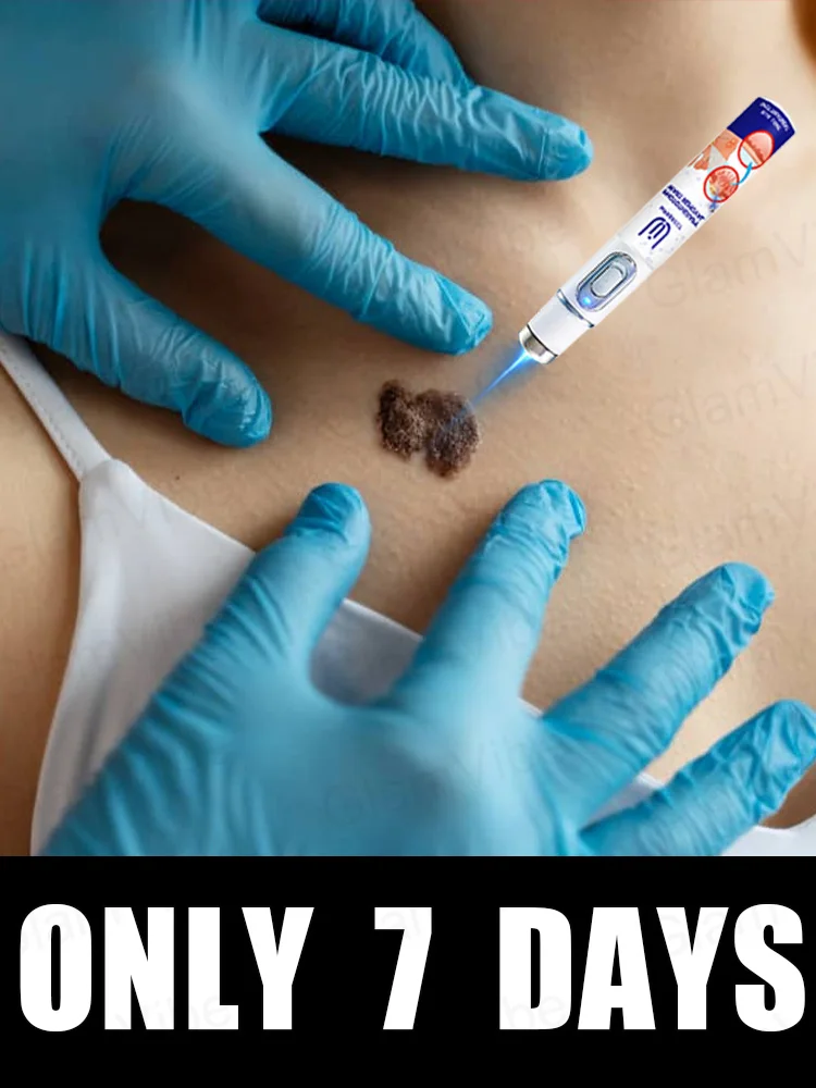 

blue light pen solve warts, hot sale wart care tools