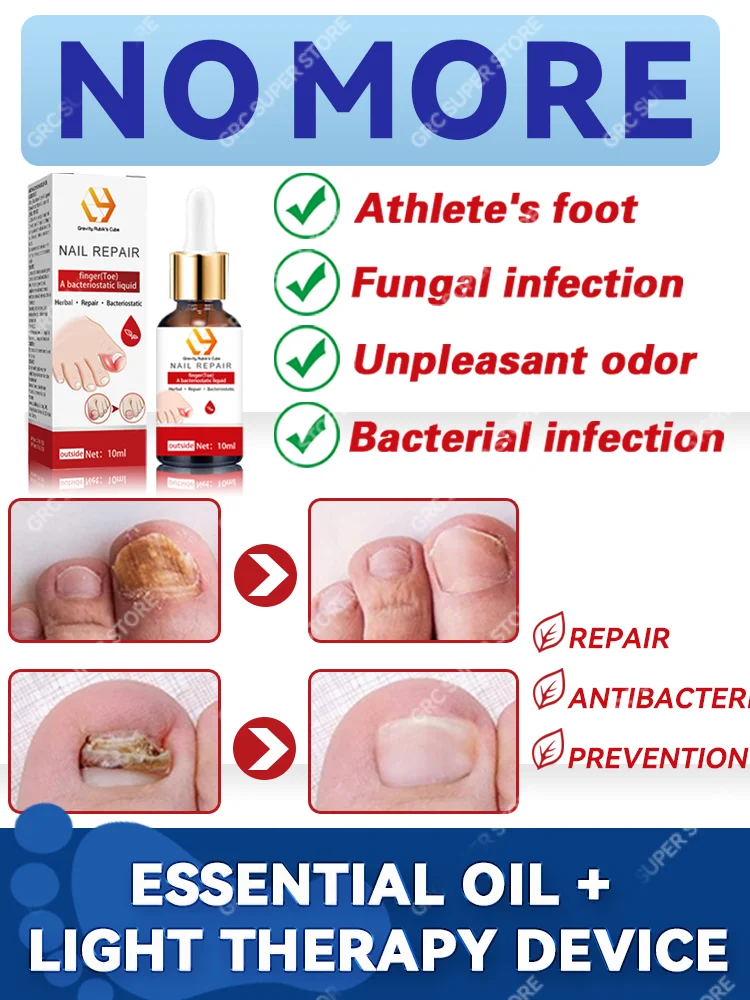 เซรั่มเท้าด้วยน้ํามันหอมระเหย onychomycosis ประสบการณ์การซ่อมแซม 7 วัน