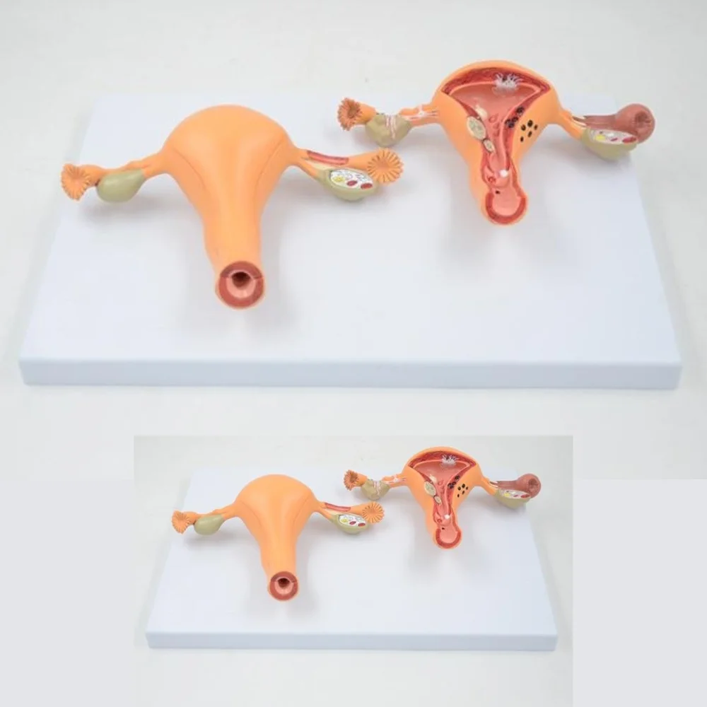 Normal and Pathologic Uterus Comparison Model Human Anatomical Medical Skills Training Simulator Educational Assistance Equipmen