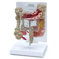 Colon Model Human Body Anatomy Replica of Colon w/Common Pathologies for Doctors Office Educational Tool