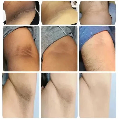 Imagen 2 del producto Crema iluminadora para las partes íntimas del cuerpo, elimina los pigmentos opacos, suero para iluminar los codos y los nudillos, producto para el cuidado de la piel