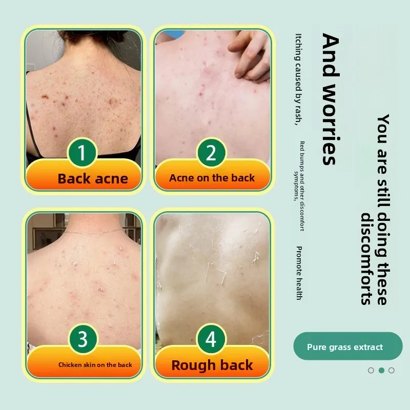 60ml Back Acne Spray - BHA Salicylic Acid Treatment for Body Breakouts, Itch Relief & Skin Purifying, Clear Skin Solution - view 2