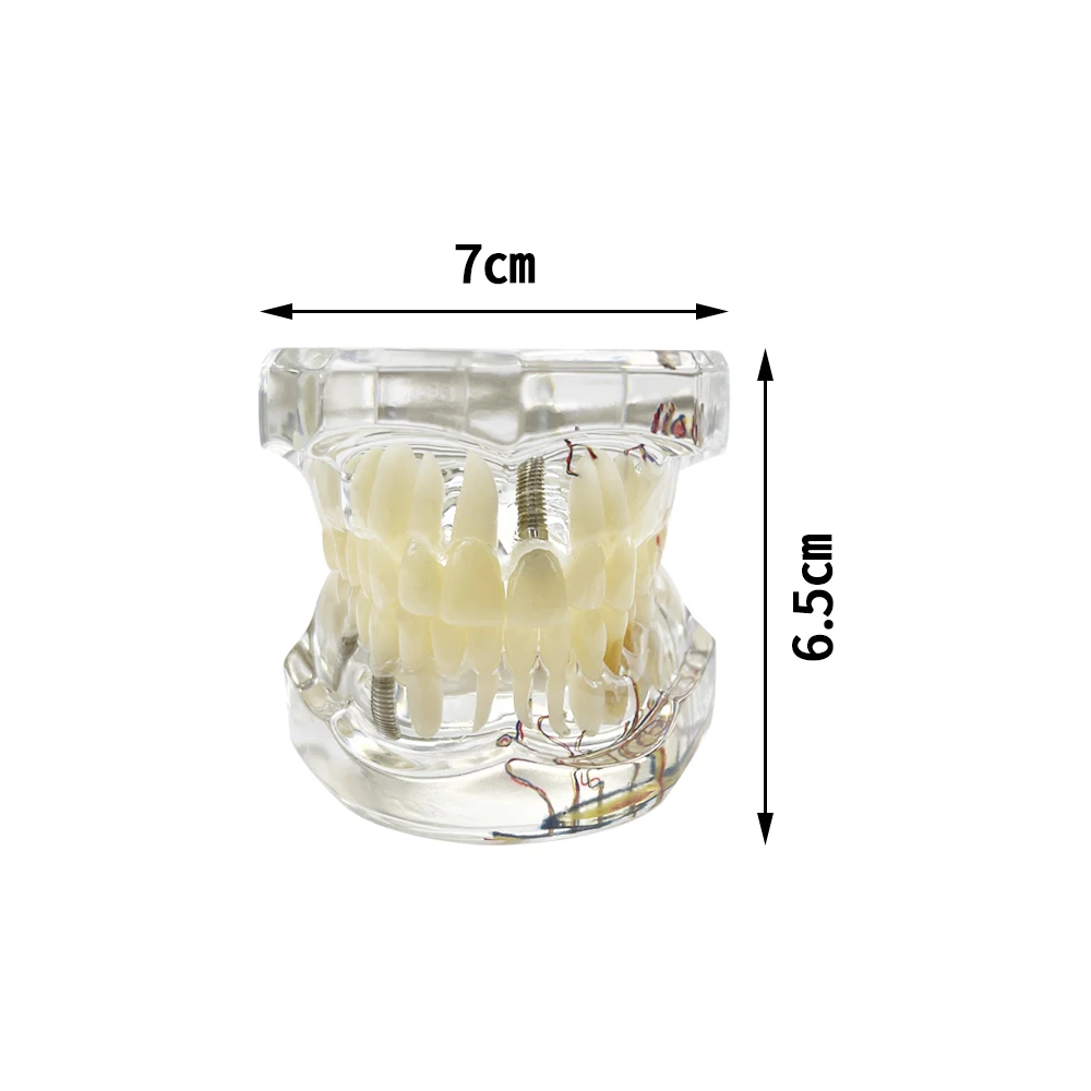 歯科モデルのインプラント病、歯のモデル、生物学的修復、歯科医の学習のための取り外し可能なティーチングタイポドント