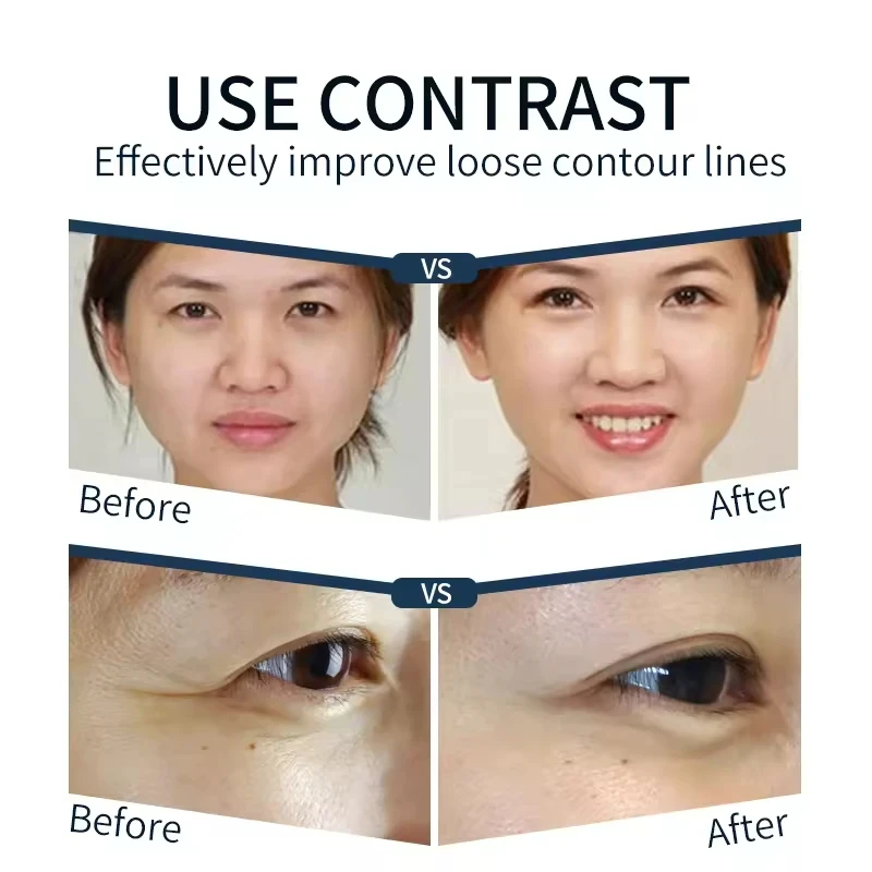 I-cool Precise Anti-Aging Facial Lifting Tightening Eye Bag Wrinkles Removal Machine Skin Repair Multi-functional RF Device