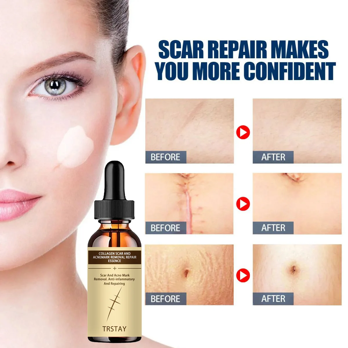 

Aichun scar lightening hyaluronic acid stock solution skin moisturizing and moisturizing imprint lightening stock solution