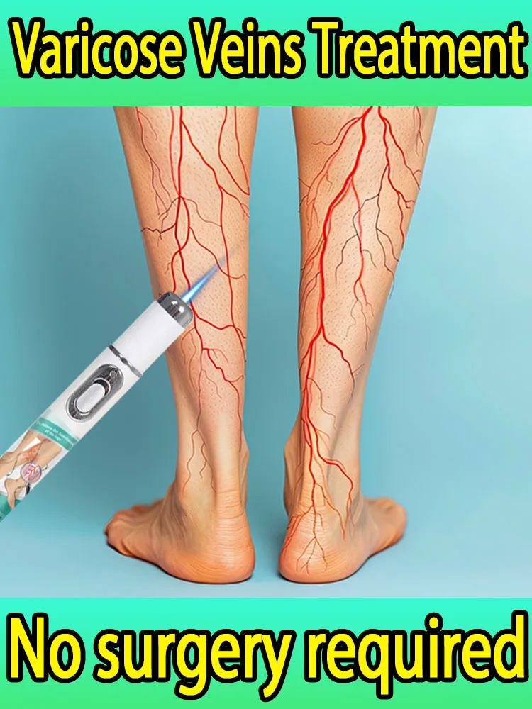 

Varicose veins in thighs eliminated in 7 days