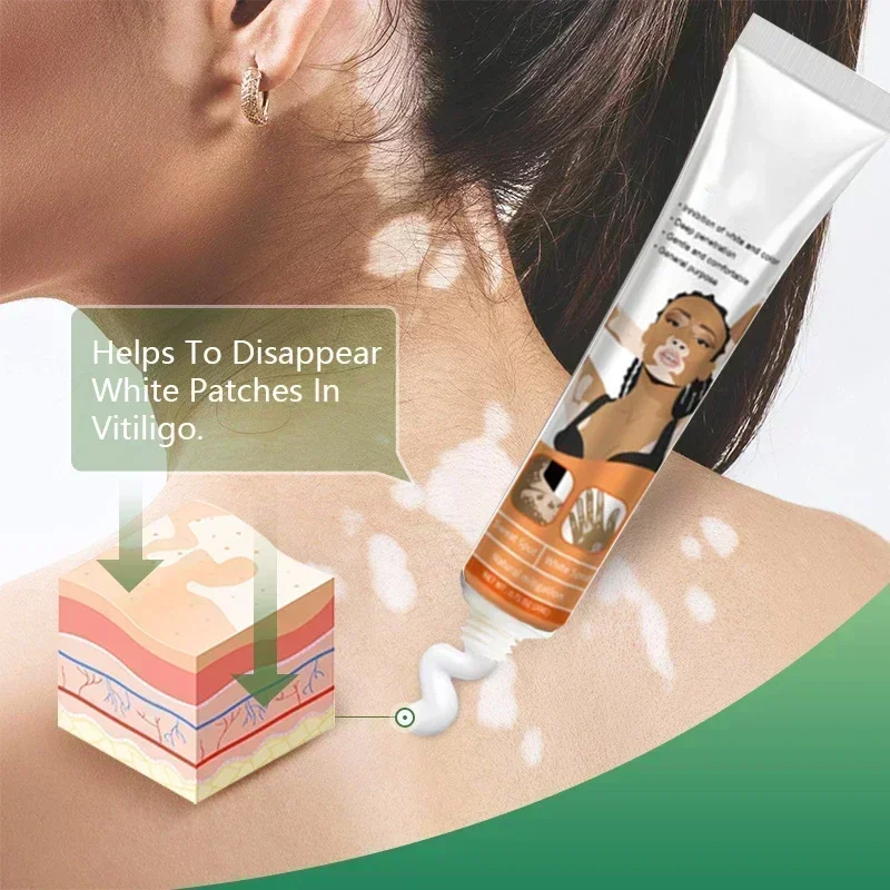 HEIßER VERKAUF Entfernen Sie effektiv Vitiligo-Salbe Creme Ringworm White Spot Removal Skin Vitiligo Beseitigen Sie die Vitiligo-Hautpflege0903