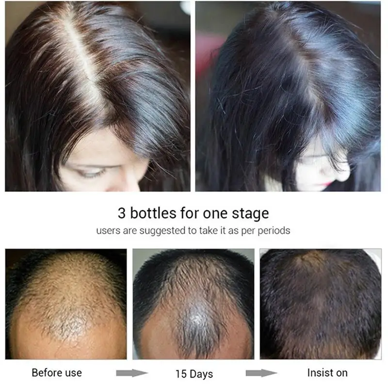 Produk semprot penumbuh rambut cepat Serum pencegah kebotakan perawatan kulit kepala minyak esensial rusak kering kecantikan rambut