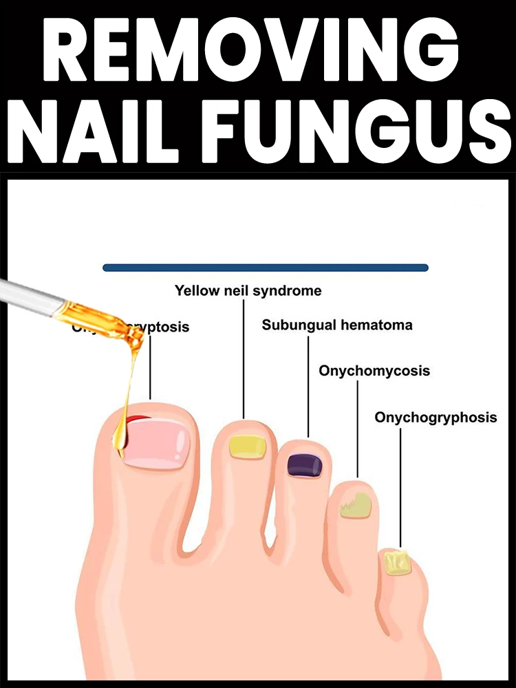 

Tea Tree nail care equipment, nail repair tools and equipment, anti-onychomycosis safe and controllable
