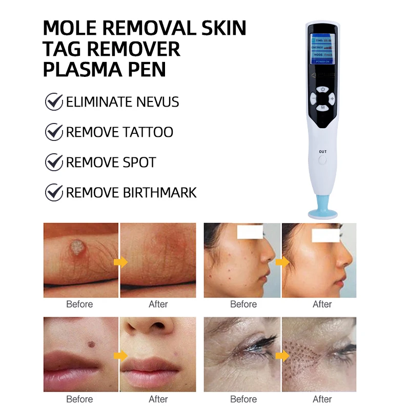 2 in1 Ozone Plasma Pen Professional Mole Removal Pen Black Spot Papilloma Wart Mole Acne Removal Beauty Device Skin Care Tools V