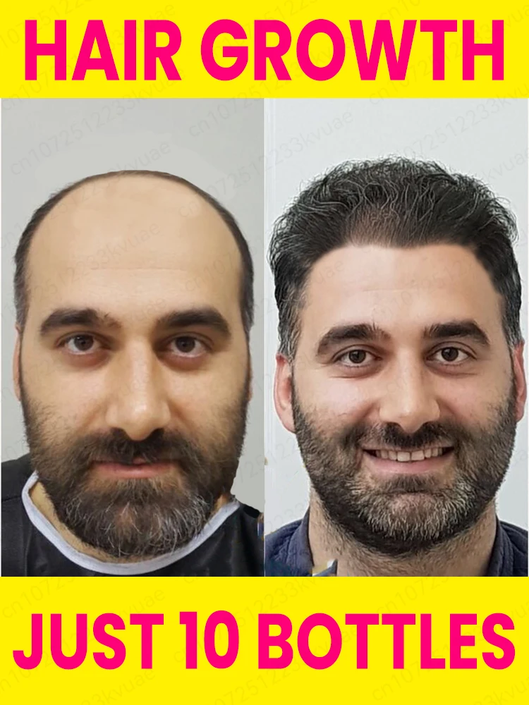 Aɴᴛɪ ʜᴀɪʀ ʟᴏss, ʜᴀɪʀ ғᴀsᴛ ɢʀᴏᴡᴛʜ ɴᴜᴛʀɪᴛɪᴏɴ ᴇssᴇɴᴄᴇ