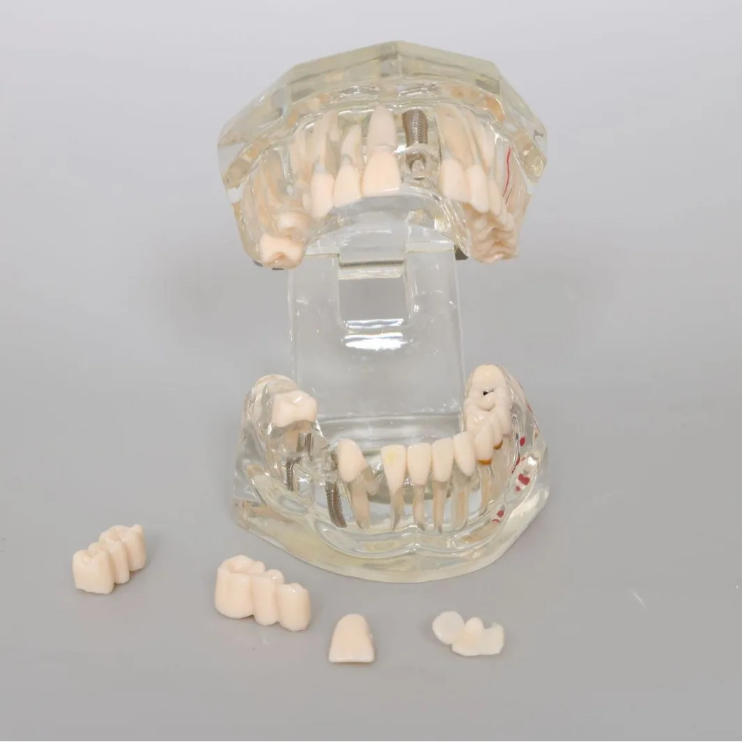 2pcs Dental Oral Transparent Restoration Dental Model Implant Nail Display Dental Model Pathology Display Teaching