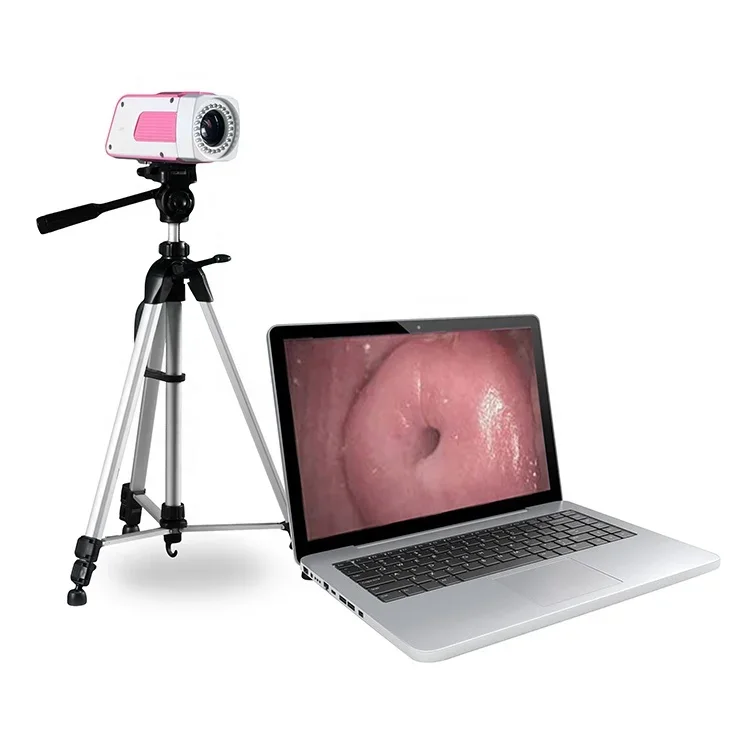 SW-3301 Portable Digital Colposcope / Laptop Digital Video Colposcope /Colposcope with Software