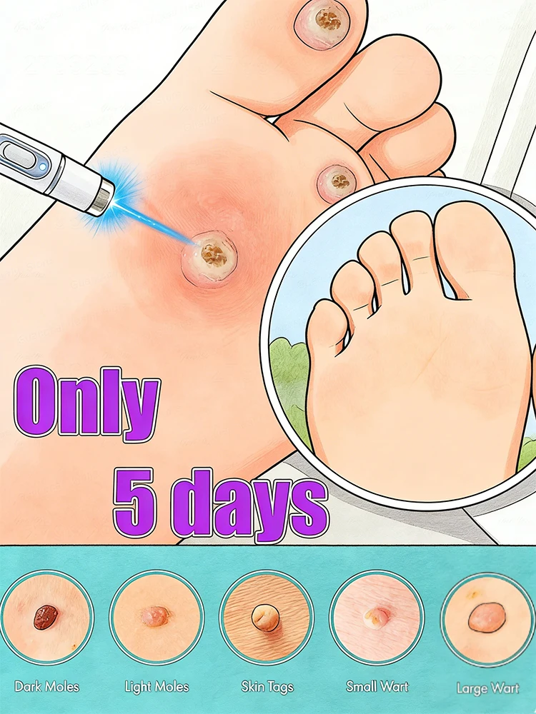 

Технологии меняет жизнь: Скажи прощайтесь на бородавки в течение 5 дней.