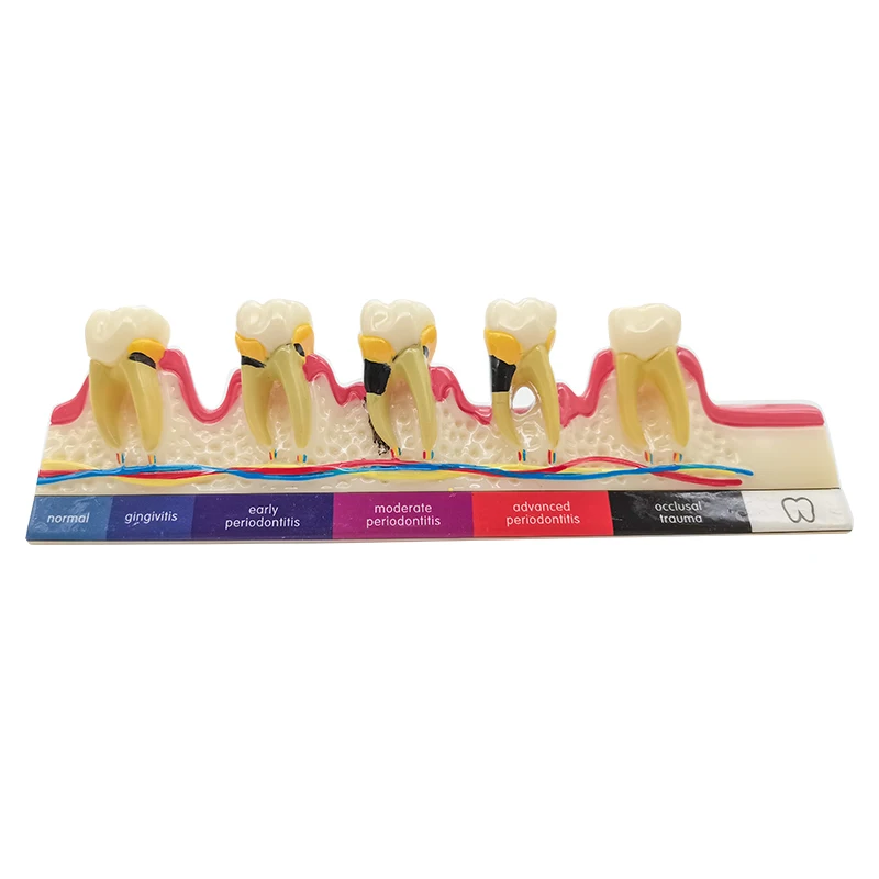 Dental Model Disease Tooth Model Tooth Dental Teaching Model for Dentist Teaching Training Learning Doctor-patient Communication