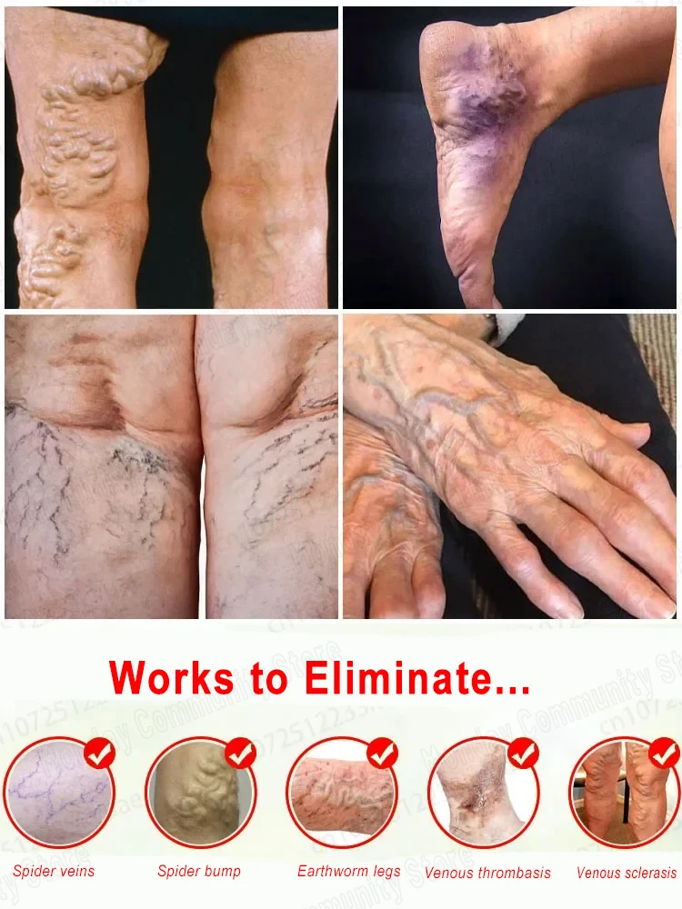 Rapid removal of varicose veins, phlebitis, venous dilatation, spider legs