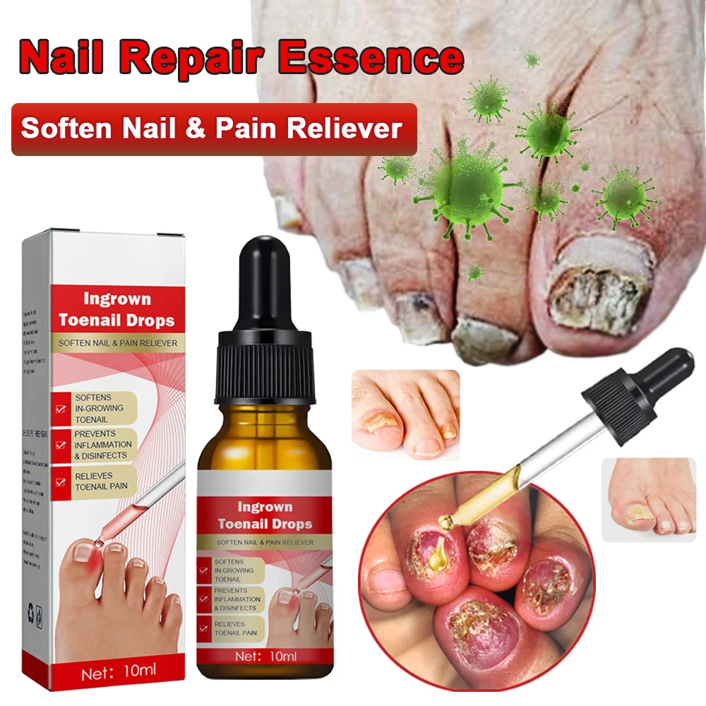 Nail Repair Essence Onychomycosis Nail Fungus Laser Treatment Device Anti Infection Paronychia Ingrown Toenail Foot Care Device