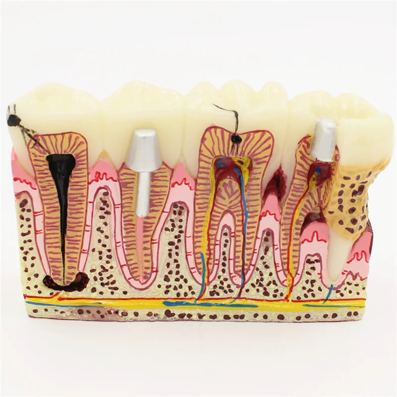 Dental Study Teaching Model Dental Impant Standard Model Removable Teeth ADULT Child TYPODONT Model Dentist Communication Model