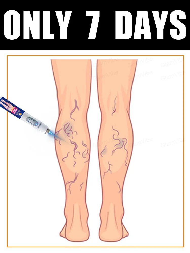 

No more tight veins in 7 days