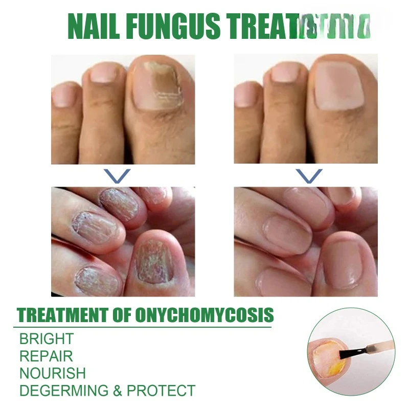 Onycho mykose Reparatur lösung Zehen nagel Teebaumöl Finger dicken weichen Nagel behandeln Pilz Anti-Infektion Hand Fuß Nägel Pflege Serum