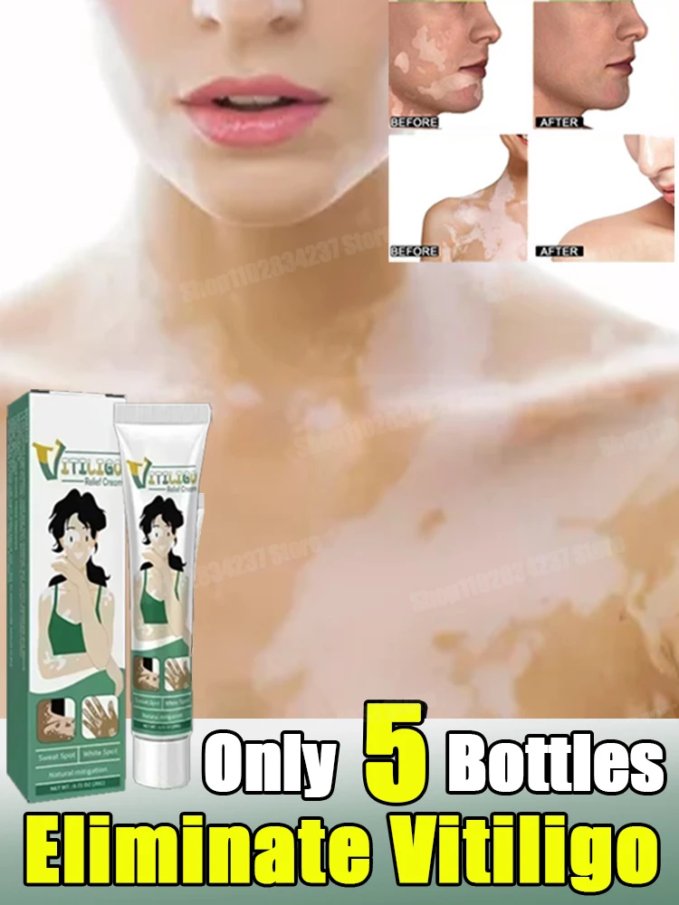 Vitiligo Repair Get Rid Of Ringworm White Spots Get Rid Of Skin Vitiligo Eliminate Vitiligo Better Body Skin