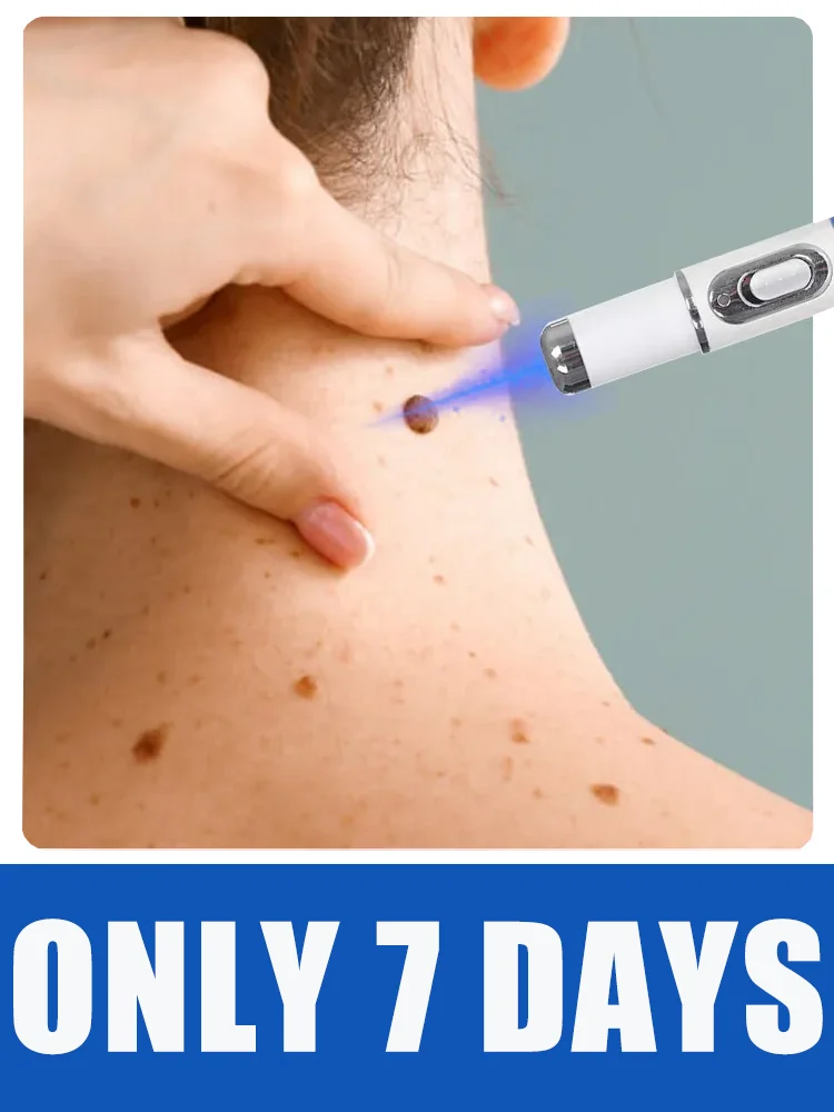 

Hot selling blue light pen to solve body warts, wart care tools