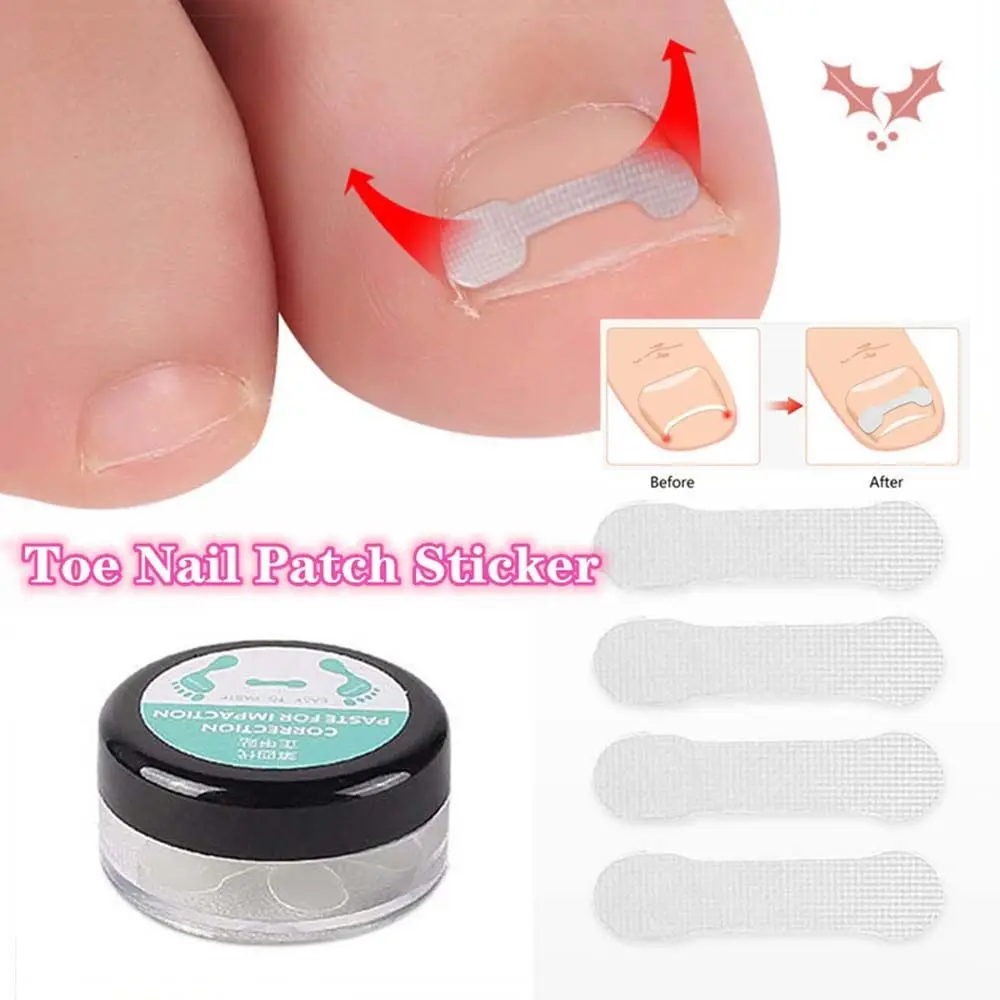 Gereedschap Pedicure Patch Orthotische Correctie Sticker Nagel Correctie Tabletten Teennagel Ortho Sticker Ingegroeide Teennagels Stickers