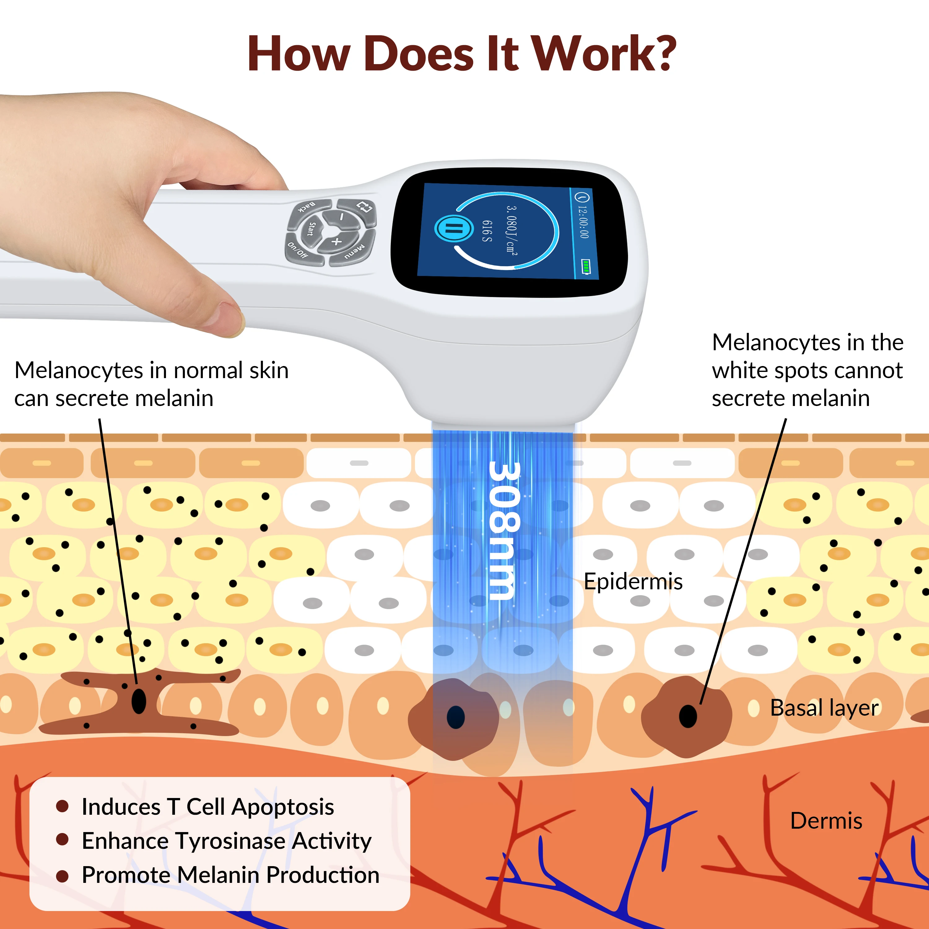 Medical 308 nm Excimer Narrowband UVB Narrow Band UV Light at Home Remedy Therapy Treatment for Eczema Vitiligo Skin Conditions