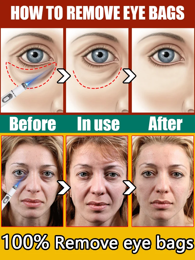 Laser Pen for Dark Circle and Eye Bag Removal