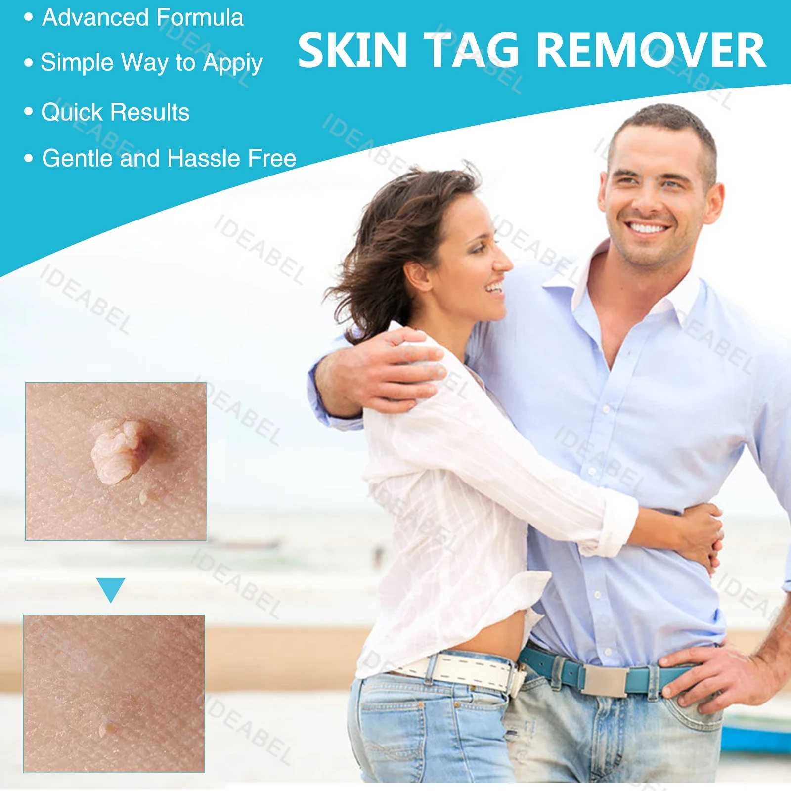 3-in-1 Auto Skin Tag Removal Kit Pijnloos Mol Wrattenverwijderaar Apparatuur Micro Skin Tag Treatment Tool Gemakkelijk schoon te maken Huidverzorgingstool