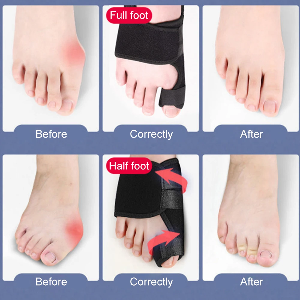 1 Paar Verstelbare Zachte Bunion Spalken Brace Grote Teen Stijltangen Afscheiders Teen Bretels Teen Correctie Spalk