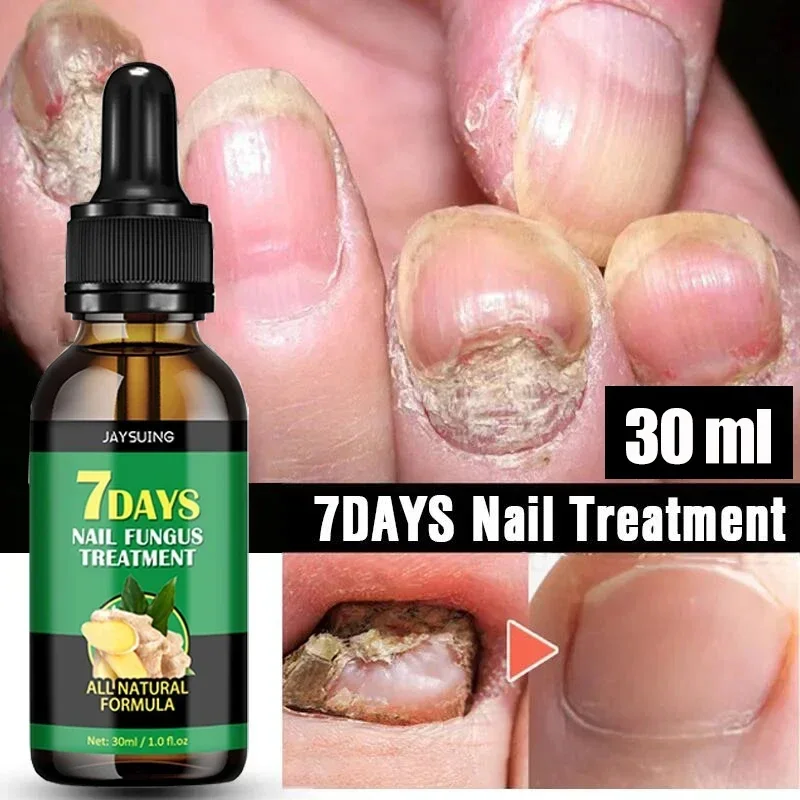 

Nail Fungal Treatment Serum Hand Foot Care Products Toe Nail Fungus Removal Anti Infection Onychomycosis Paronychia Repair