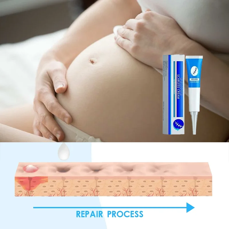 

Remove Pregnancy Scars Acne Cream Stretch Marks Treatment Maternity Repair Anti-Aging Anti-Winkles Firming Body Creams
