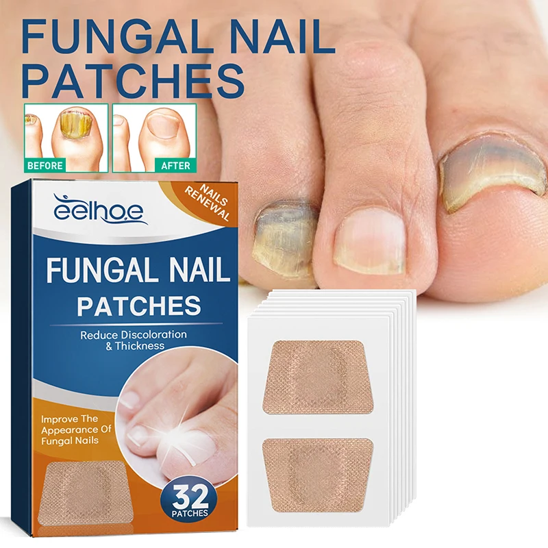 Parche de reparación de uñas fungicida gris, tratamiento de paroniquia suave, antiinfección pegatina de corrección, cuidado de las uñas encarnadas