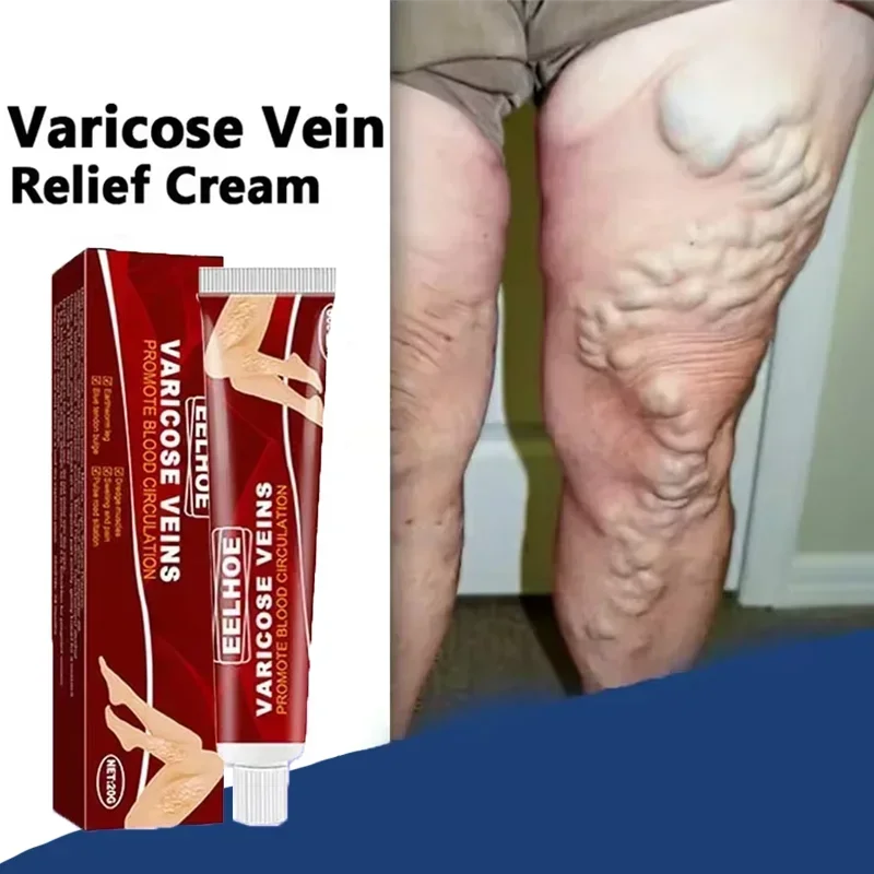 

Ointment for Varicose Veins Eliminate Vasculitis Phlebitis to Relieve Spider Leg Pain Treatment Herbal cream