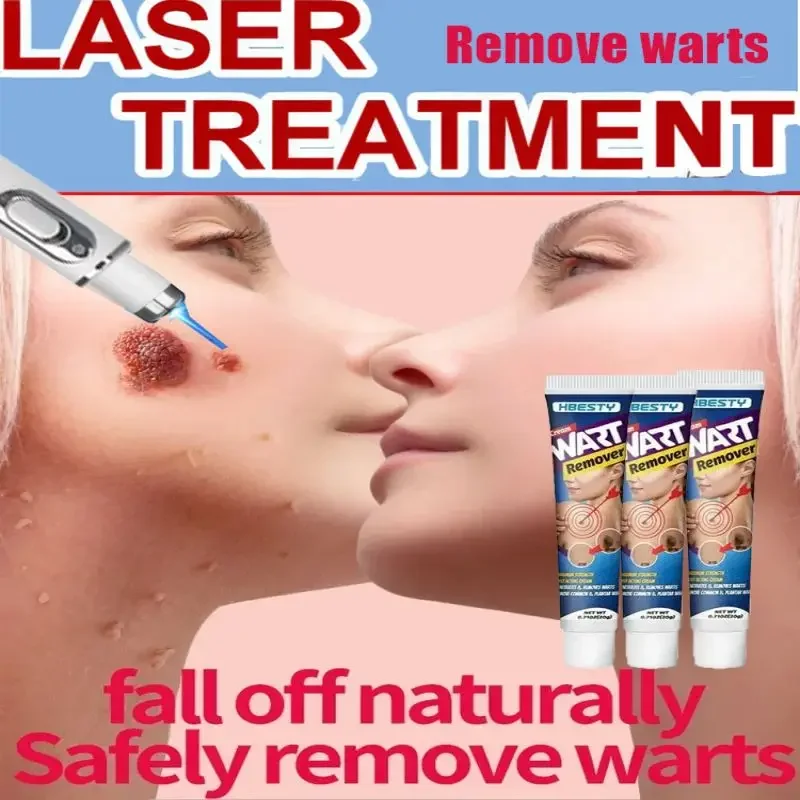 Laser Pen Rapid Wart Removal Agent - treats plantar and genital warts, attacks warts upon contact, easy to use laser pen