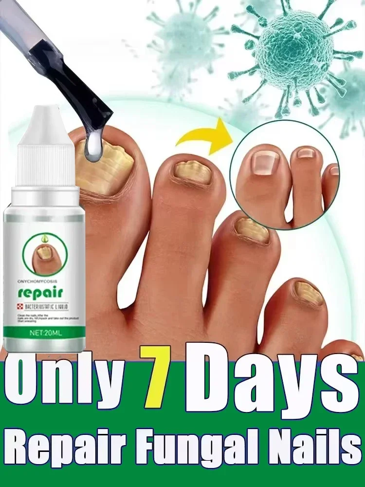 

Toenail Nail Fungus Treatment Repair Fingernail Device Toenail Treatment for Foot Nail Fungus Essential Oil Onychomycosis Care