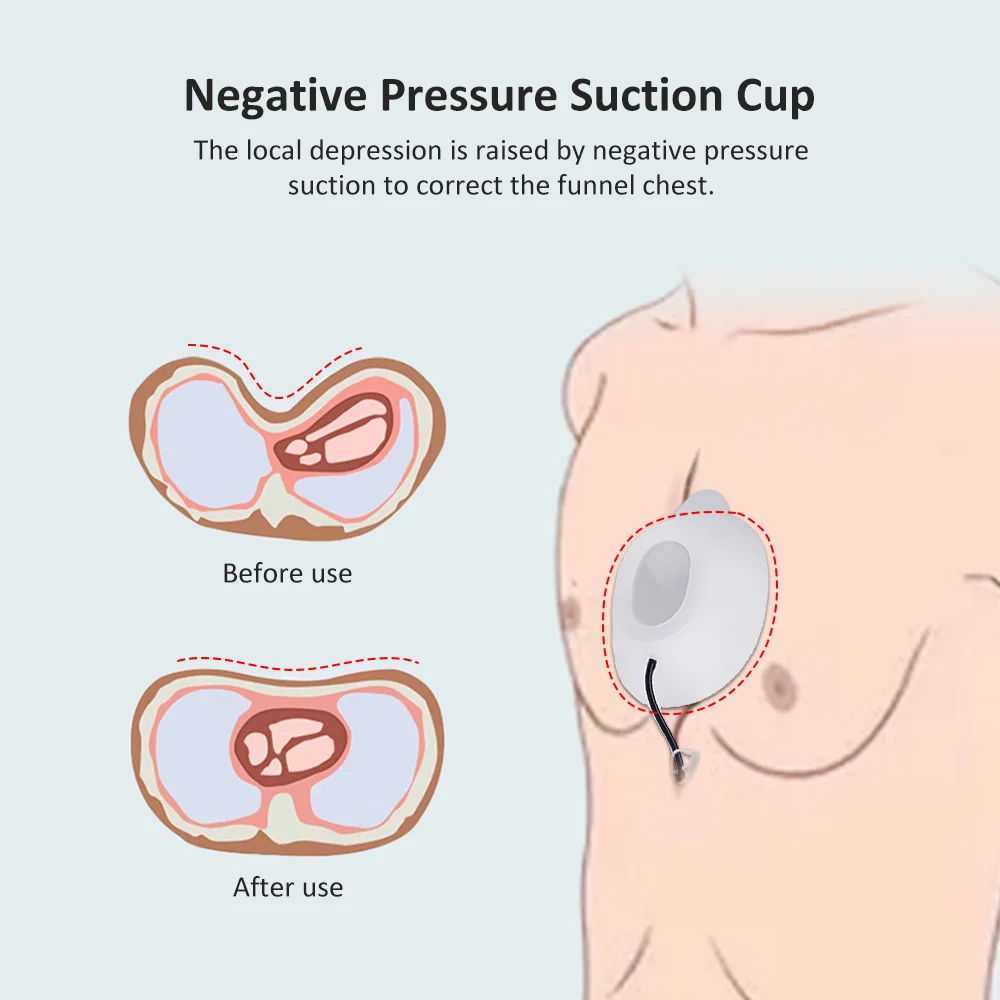 Pectus Excavatum الجبيرة هدفين الاكتئاب الخافتي دعم الاكتئاب الصدري الغارقة القص للبالغين الطفل المادية الصحيحة