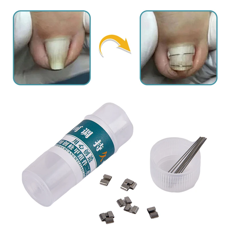 Corretor de unhas encravadas, ferramentas para pedicure, recuperação, tratamento de unhas encravadas, profissional, alisamento de unhas encravadas