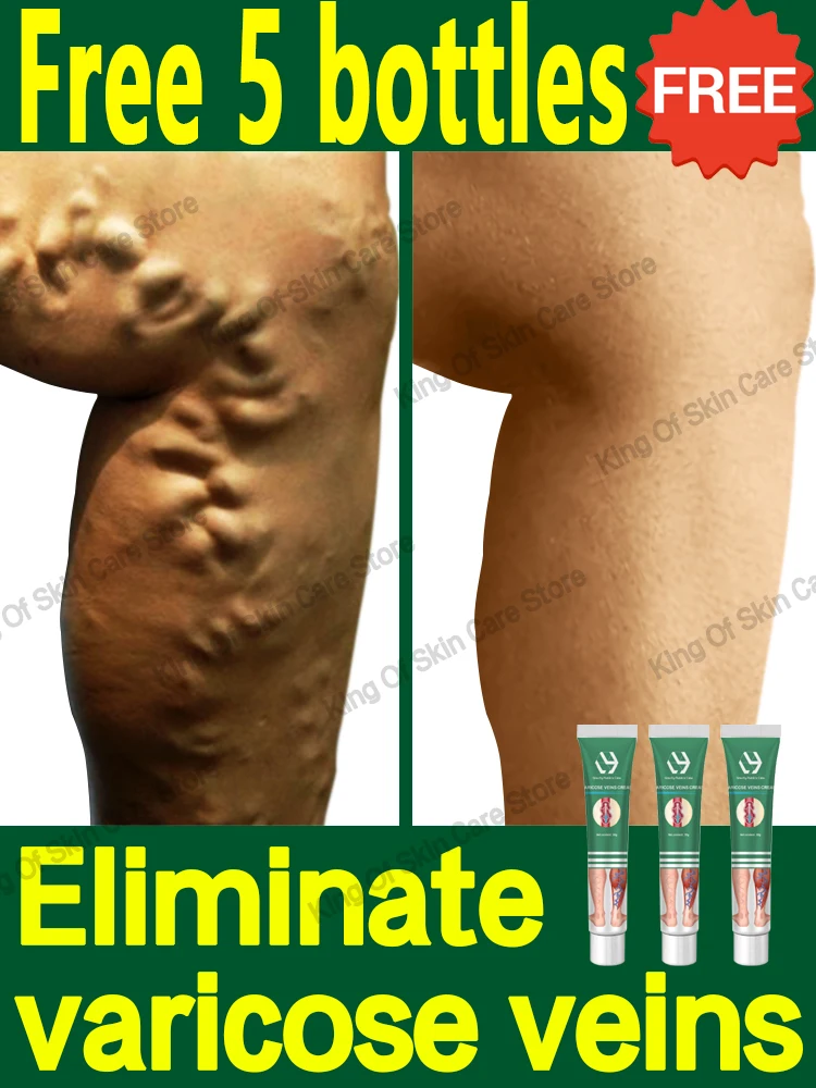 Ointment for Varicose Veins Eliminate Spider Legs Spider Vein to Relieve Vasculitis Phlebitis Spider Pain Treatment Varicose Vei