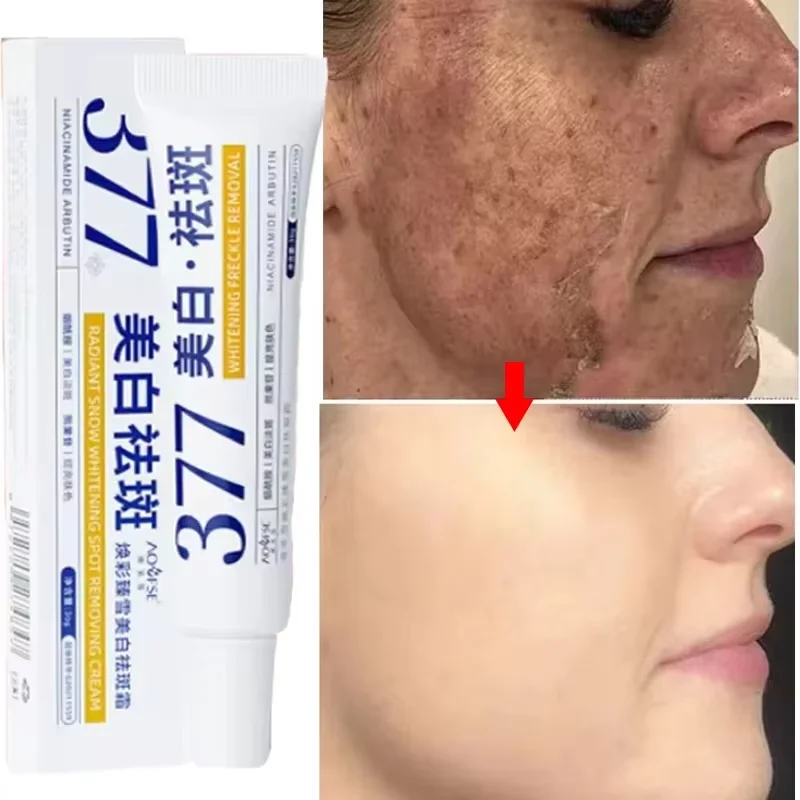 

Effective Whitening Freckle Cream 377 Remove Dark Spots Anti Freckle Cream Fade Pigmentation Melasma Brighten Skin Care Product