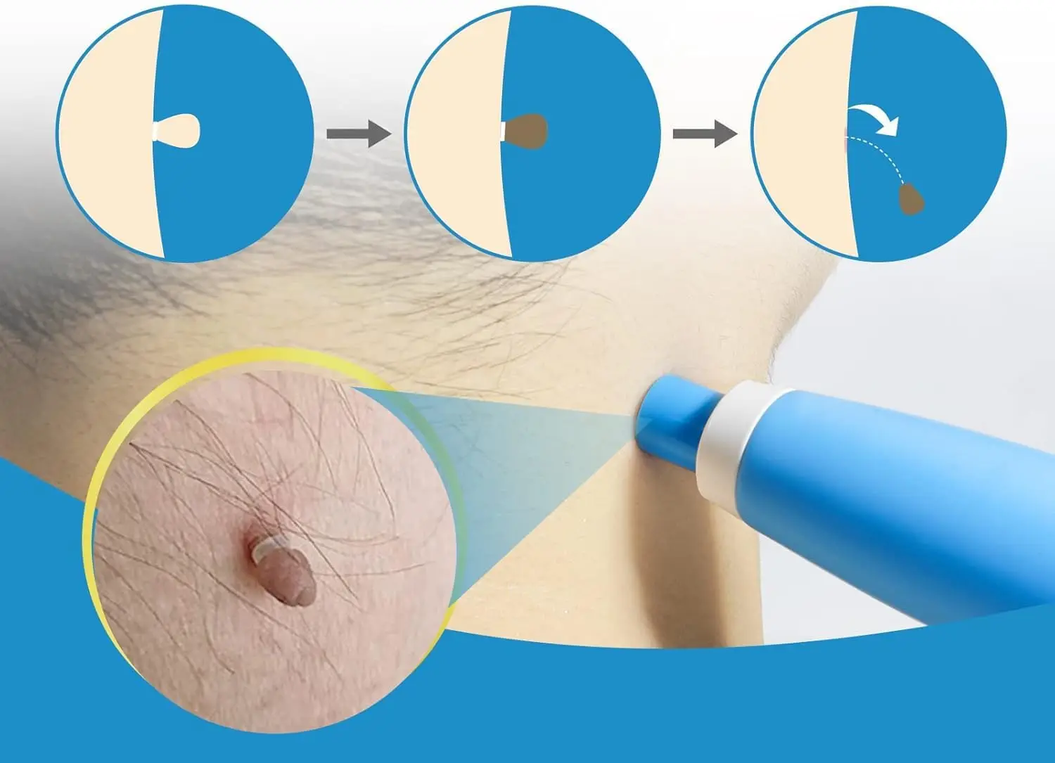 Painless Auto Skin Tag & Mole Removal Kit - Body Wart Dot Treatments Cleaning Tools for Face & Skin Care Beauty Health Remover