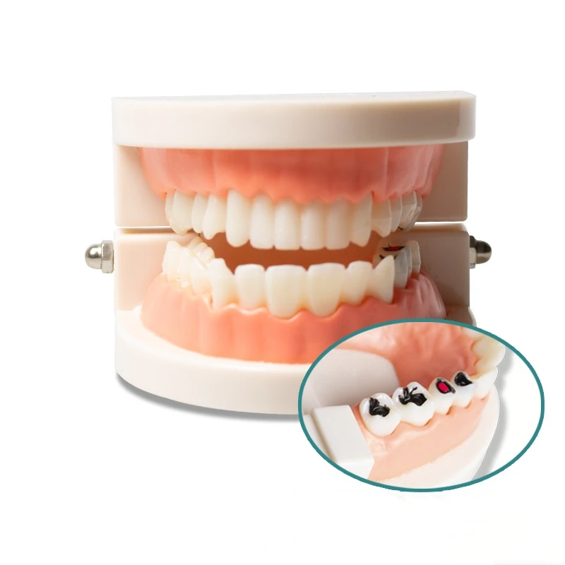 1pc Dental Teeth Model Standard Teeth Teaching Tooth Decay Comparsion Demonstration Model Dentistry Lab Teeth Learn Material