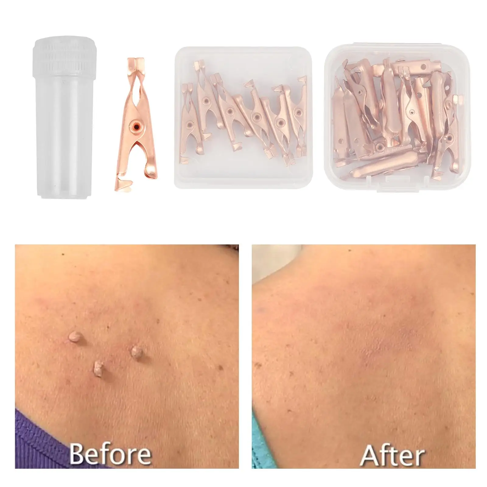 مشابك إزالة علامات الجلد الصغيرة، علامة نحاسية، مستخرج علامات الثآليل للجنسين #4