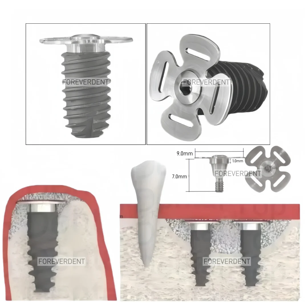 

Стоматологические аксессуары Auodonta: База для синус-лифтинга, винт для базы, титановый сплав, аксессуары для дентальных имплантатов, колпачок для базы синус-лифтинга